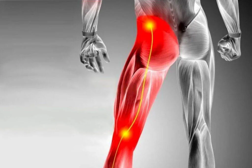 Sciatica-Pain-–-Symptoms-Triggers-Neurological-Treatments